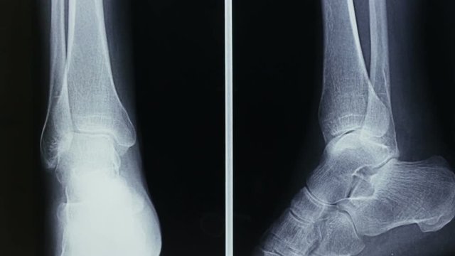 Vertical tracking of a radiograph of the bones of the human foot, in frontal and lateral view.