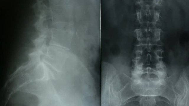 Vertical tracking of a radiograph of the bones of the human pelvis, in frontal and lateral view.