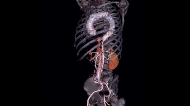 CTA abdominal aorta 3D rendering image with transparent skeletal showing of aortic dissection.