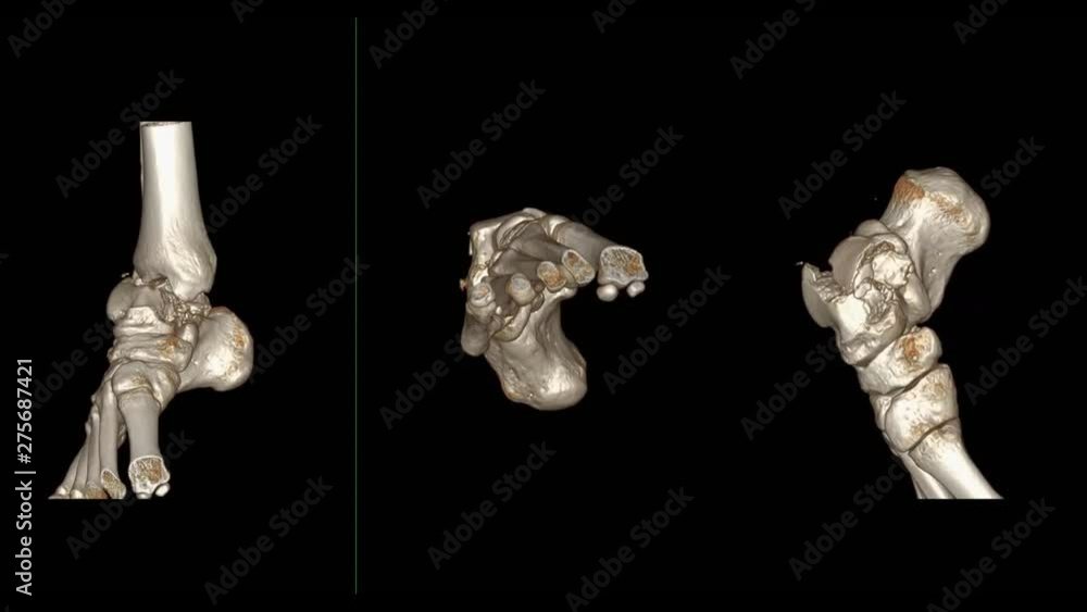 Poster ct ankle joint or ct scan of right ankle 3d rendering image rotating on the screen showing fracture 