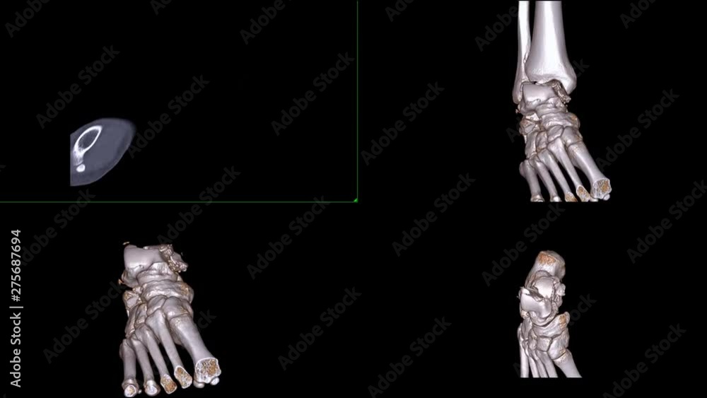 Poster multi view of ct ankle joint or ct scan of right ankle 2d sagittal plane and 3d rendering showing fr