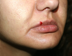 Naklejka premium Crack on the lip. Blood on the upper lip