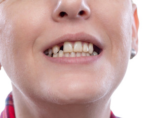 Tooth pain and dentistry, broken teeth - woman broken teeth damaged cracked front tooth need...