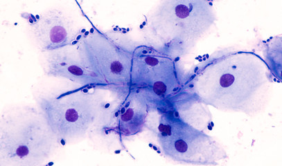 Endoscopic esophageal brushing cytology showing squamous cells with yeast and pseudohyphae of...