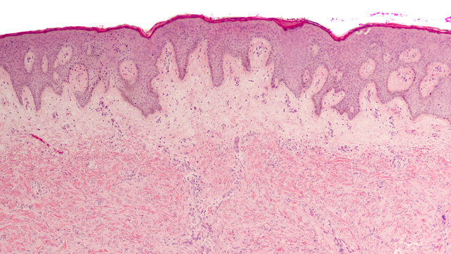 Tumors of Skin: Microscopic image (photomicrograph) of a dermatofibroma, a benign lesion that presents as a bump (papule), often pigmented.  H&E stain.  