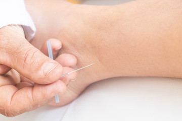Acupuncture needles on the legs and foot