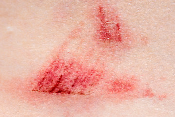 A wound on the human body. Very close up of painful wound