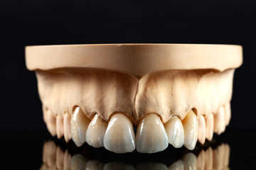 Close-up view of dental layout of upper veneers