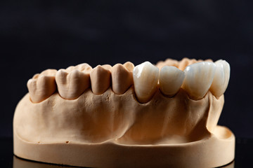 Fototapeta na wymiar Close-up view of dental layout of upper veneers