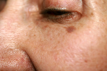 Pigmentation on the face. Brown spot on cheek. Pigment spot on the skin.