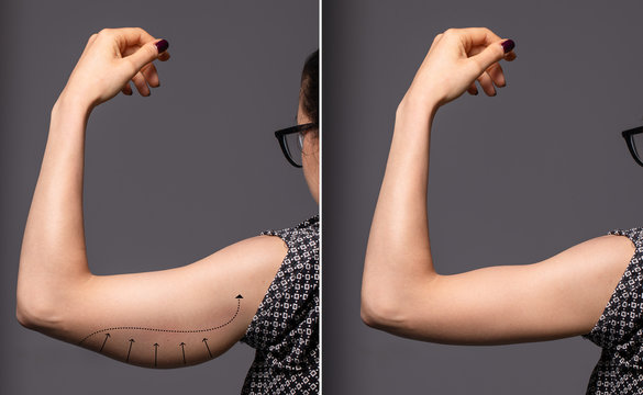 A before and after view of a successful brachioplasty procedure. An untoned arm is seen on the left before plastic surgery, and a toned arm is seen on the right after the operation.