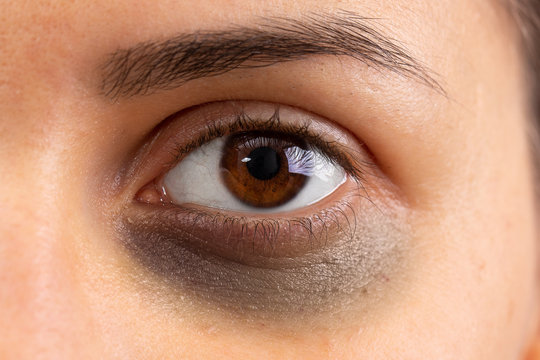An extreme close up view on a beautiful girl with a black eye. Contusion in the lower eye area caused by a punch to the face. Physical violence concept.