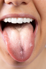 Obraz premium An extreme closeup view on the tongue of a young Caucasian lady suffering from oral candidiasis. White furry tongue, a common symptom of a fungal infection in the mouth.