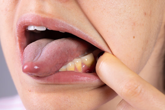 A close up view on the mouth of a young girl. She pulls her cheek away to reveal yellow plaque stained teeth. Bacteria build up on the lower teeth.