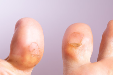 Fototapeta premium A closeup view o the two big toes of a Caucasian person. Both have callus skin and old blisters caused from too much walking. Healed and fresh skin is seen at the blister site.