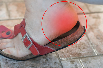 A close up view on the heel and foot of an active adult. Red and inflamed causing pain and...