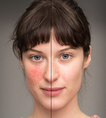 A before and after view of a beautiful young Caucasian girl suffering with rosacea. Portrait view...