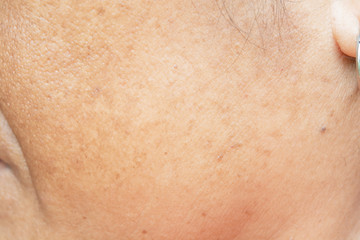 Fototapeta premium freckles on the face. in old women