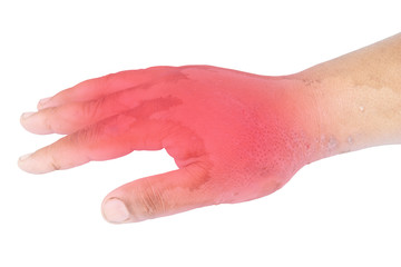 Blisters from hot water in hand