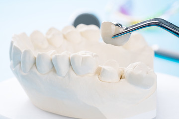 Fototapeta na wymiar Close up Implan model tooth support fix bridge implan and crown.