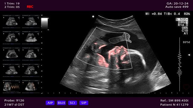 Unborn baby gives Thumbs up from the womb. Ultrasound sonogram pregnancy scan screen. The child is trying to say that he is ok.