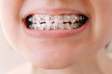 Female mouth with braces close-up, correction of malocclusion