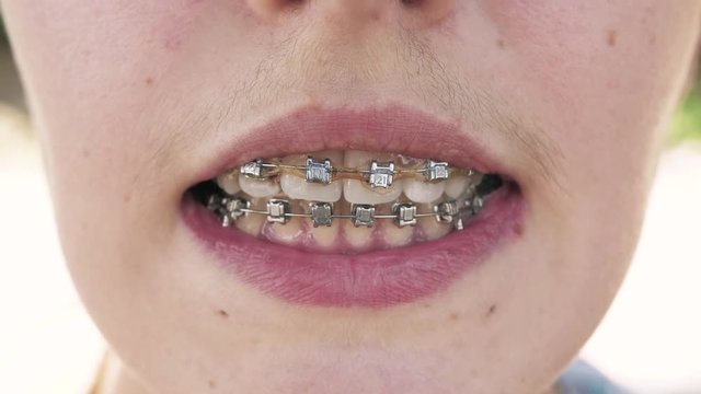 braces on the teeth of a teenager, close up