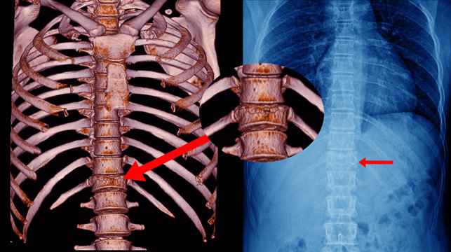 CT Scan Thoracic spine 3D and x-ray Thoracic spine finding fracture T11.