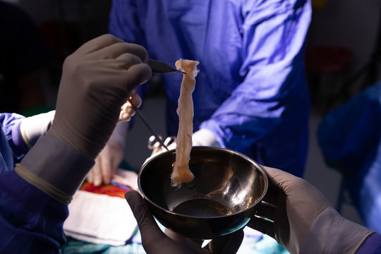 Surgeon hand putting a bit of human flesh in a bowl