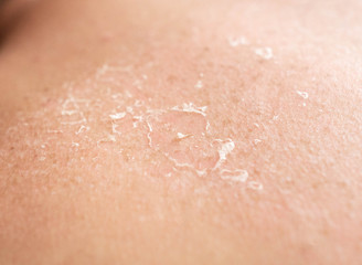 Fototapeta premium Flaking of the skin after sunburn on the back of a person, sunburn, close-up, epidermis