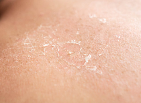 Flaking of the skin after sunburn on the back of a person, sunburn, close-up, epidermis