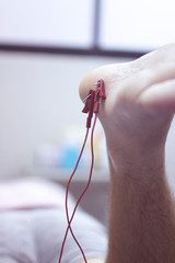 EPI dry needling physiotherapy