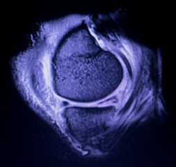 MRI knee meniscus tear scan