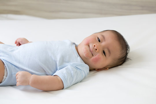 Asian baby boy lying on the bed and had a red rash on the face, Skin common rashes in newborn concept
