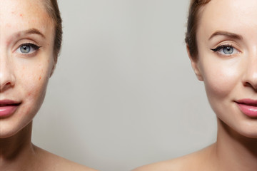 woman face portrait with clear and pimpled skin