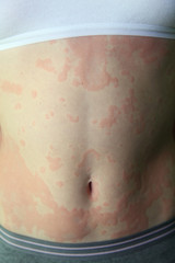 allergic dermatitis