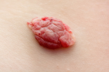 Infantile hemangioma red birthmark (also called strawberry mark) on the baby's chest. Vascular...