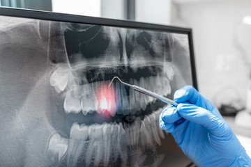 Doctor pointing teeth x-ray on computer monitor