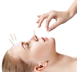 Woman undergoing acupuncture treatment. - obrazy, fototapety, plakaty