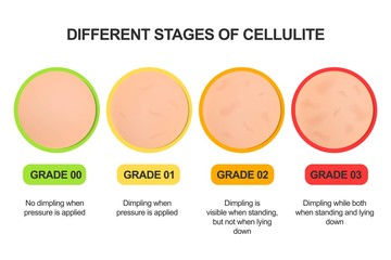 Different stages of cellulite. Grading scale. Treatments. - obrazy, fototapety, plakaty