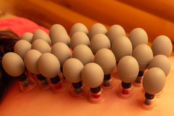 massage with vacuum cans. vacuum cans on the back of a person. massotherapy