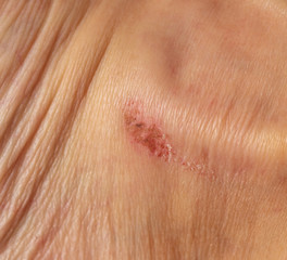 Fototapeta premium Wound on human skin as a background
