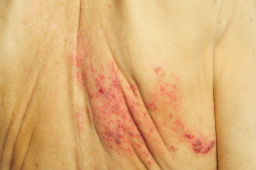 Shingles is a viral infection that causes a painful rash