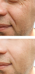 male wrinkles before and after