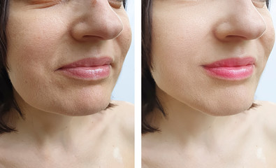 woman face wrinkles before and after treatment