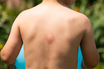 Large swollen insect bite mark on baby's back