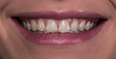 Woman smile with natural teeth