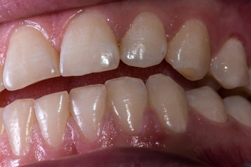 Healthy human teeth - incisors, frontal close up view