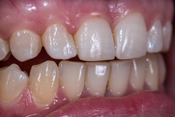 Healthy human teeth - incisors, frontal close up view