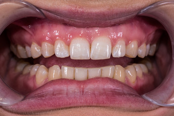 Healthy human teeth with normal occlusion from frontal intraoral view